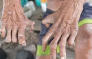 فى اليوم العالمى للجذام .. كل ماتريد معرفته عن أخطر مرض جلدي