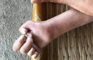 في اليوم العالمي له.. اكتشف أسباب الجذام الحقيقية