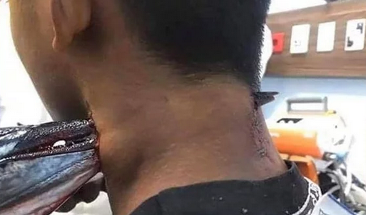 بعد هجومها على شاب في البحر وإصابته في عنقه.. معلومات عن سمكة الإبرة