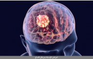 أعراض الإصابة بسرطان الدماغ .. 9 علامات تشير للإصابة بالمرض الخبيث