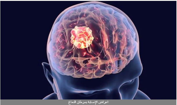 أعراض الإصابة بسرطان الدماغ .. 9 علامات تشير للإصابة بالمرض الخبيث